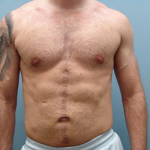 Abdominal Sculpting Surgery Before And After in Charlotte