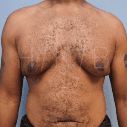 before gynecomastia surgery front view case 21132