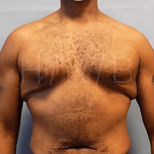 after gynecomastia surgery front view case 21132