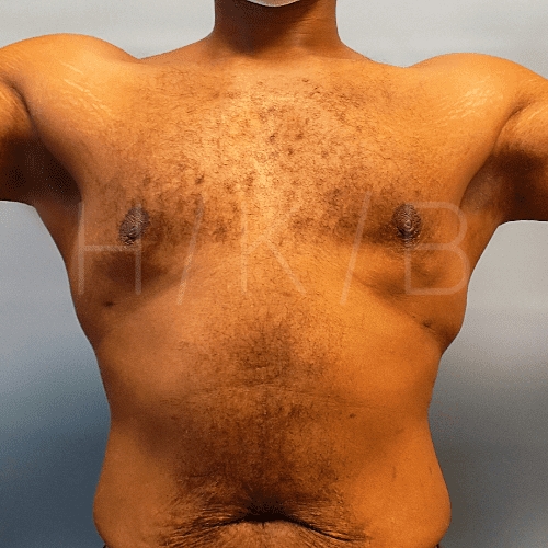 after gynecomastia surgery front view case 21132