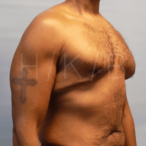 after gynecomastia surgery right angle view case 21132