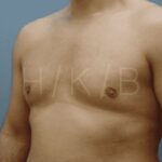 after gynecomastia surgery left angle side view case 21141