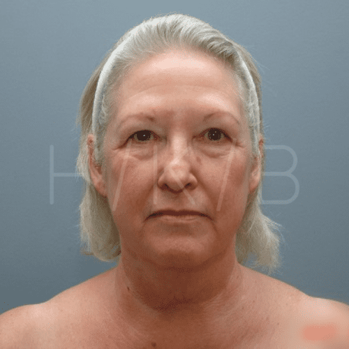 Facelift