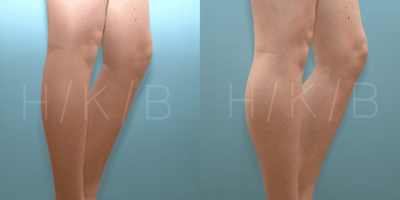 Calf Augmentation