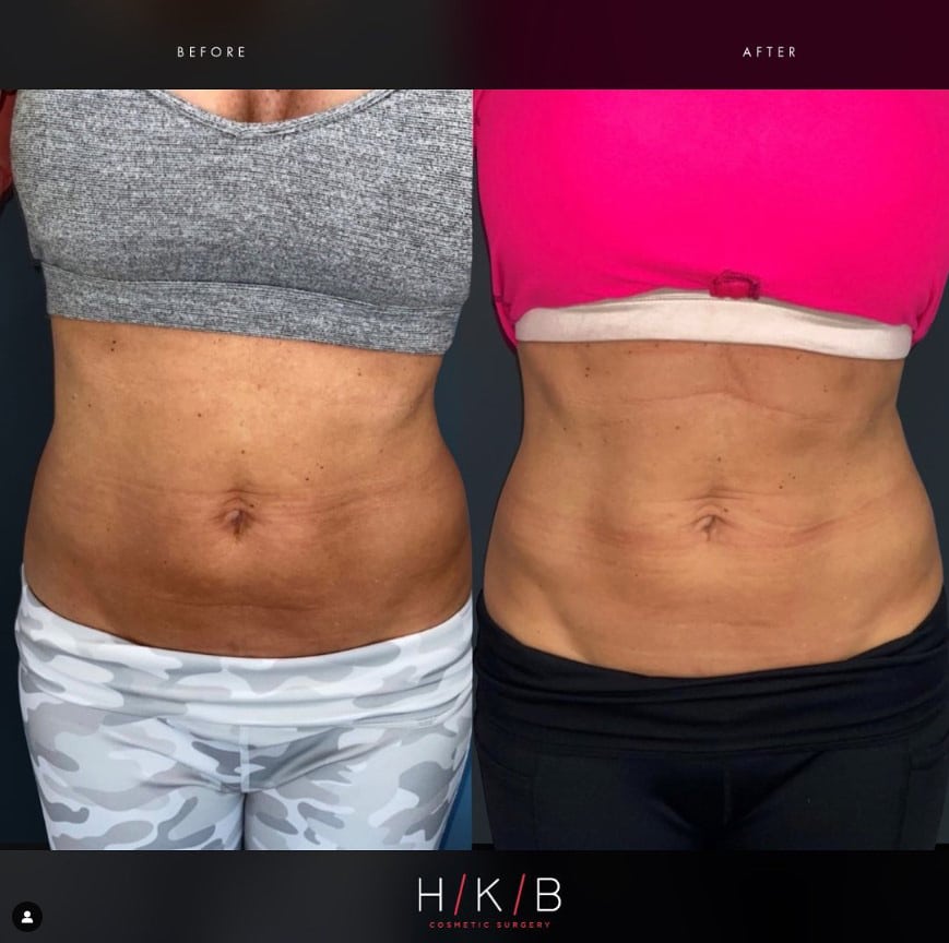 Emsculpt