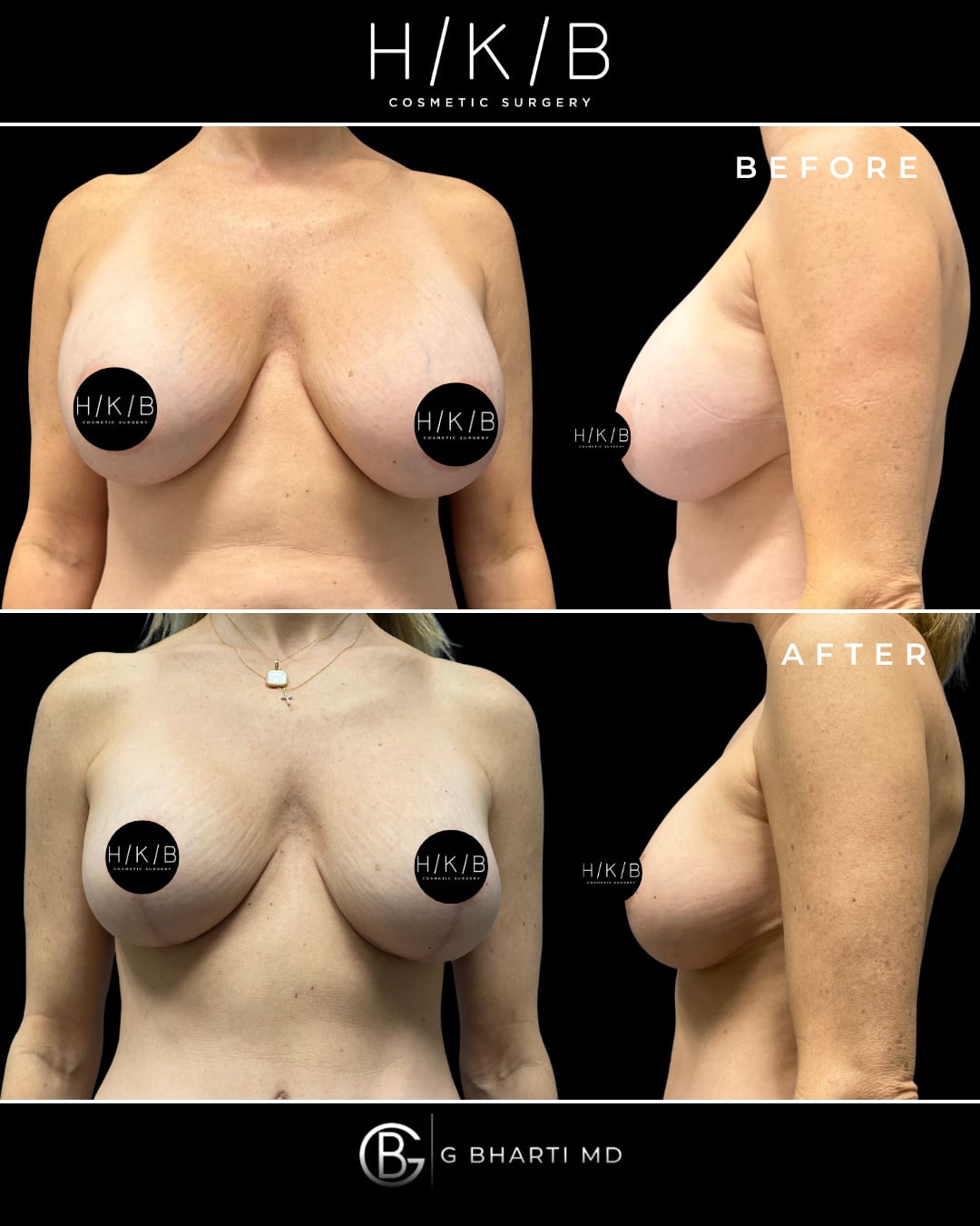 Breast Implant Exchange