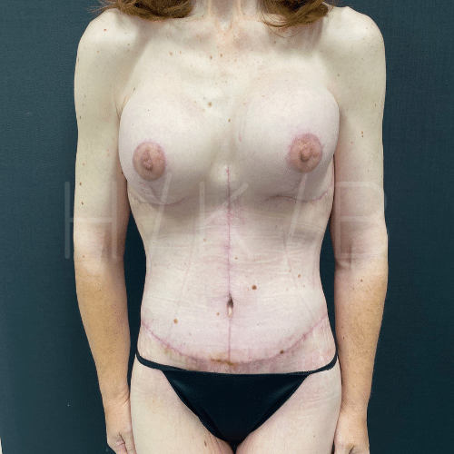 After