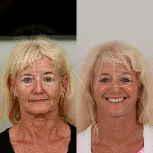 Before