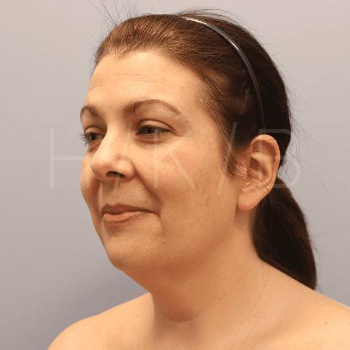 Neck Lift