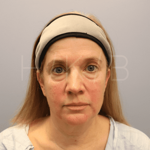 Eyelid Surgery