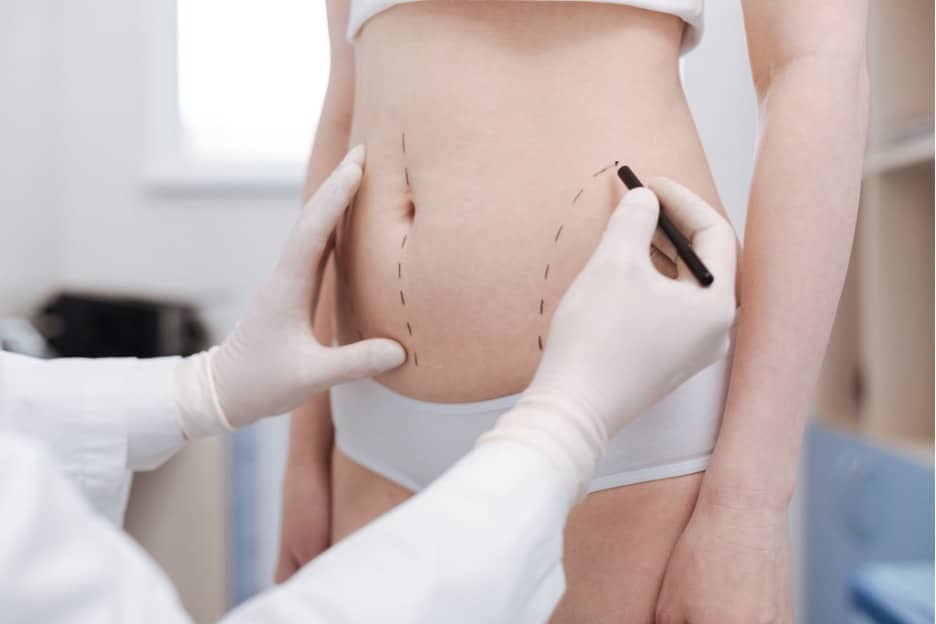 A person getting drawn on before liposuction.
